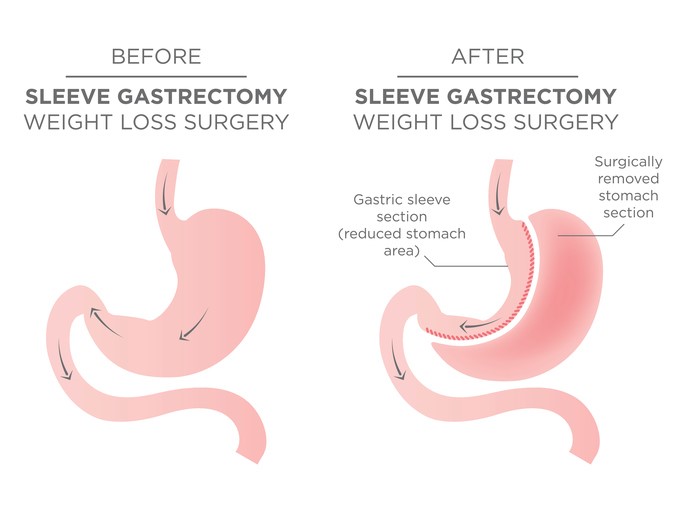 Bariatric Gastric Sleeve Before and After Skin Photos - Los Angeles