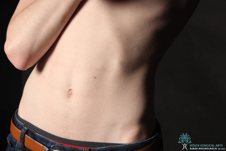 The tummy tuck was the preferred procedure - Los Angeles CA