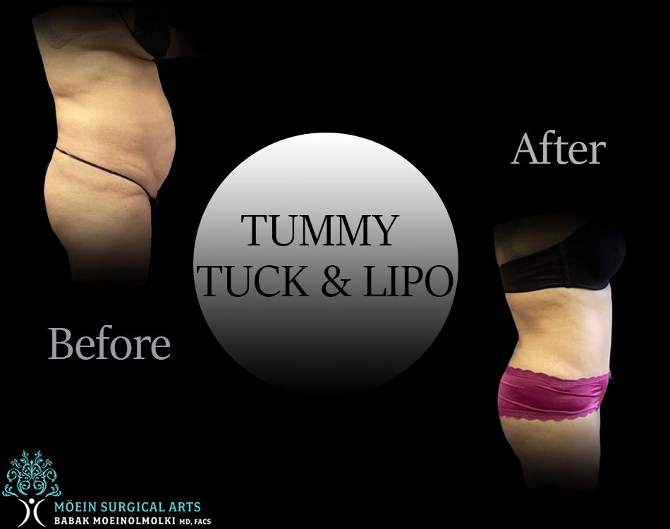 Tummy Tuck - Moein Surgical Arts