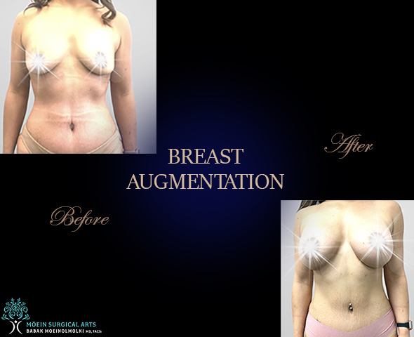 Breast Augmentation