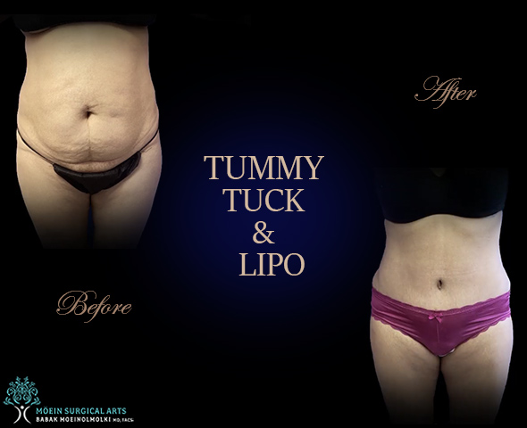 Tummy Tuck - Los Angeles