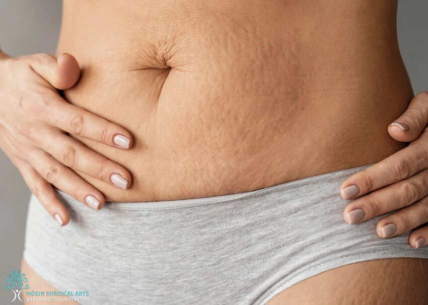 How Do Stretch Marks Form?