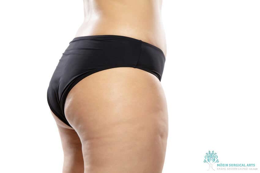 Can Thigh Cellulite Treatments Give You Smoother Skin?