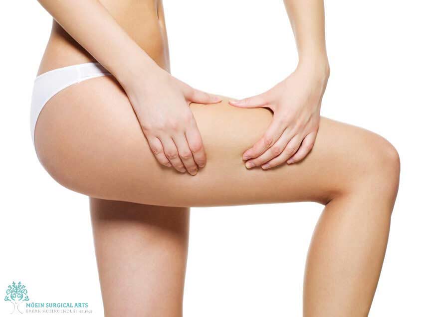 Thigh Lift Surgery in Los Angeles- Moein Surgical Arts