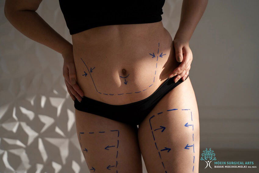 Liposuction in Los Angeles CA