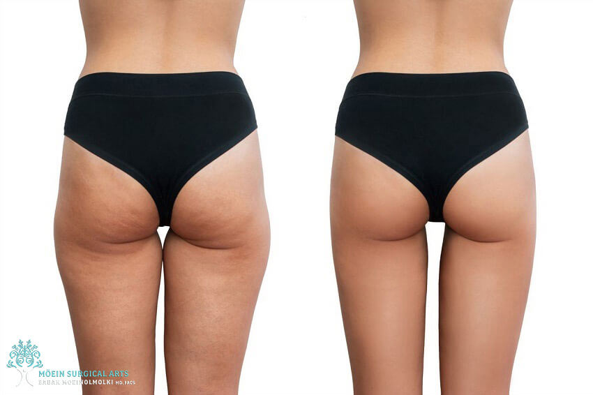 Cellulite Reduction in Los Angeles, CA