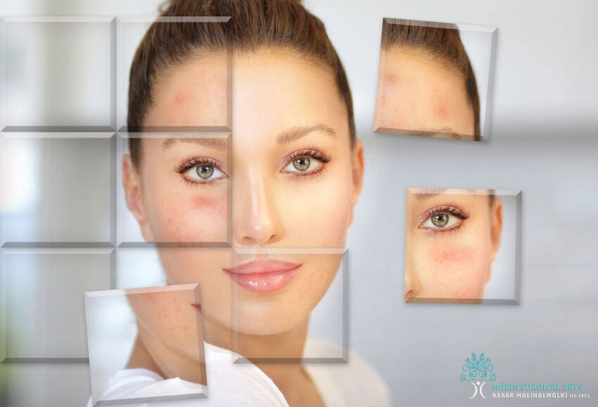 Lumecca IPL Skin Rejuvenation in Los Angeles, CA