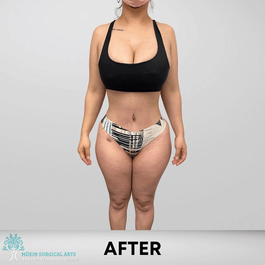 After-360-lipo copia