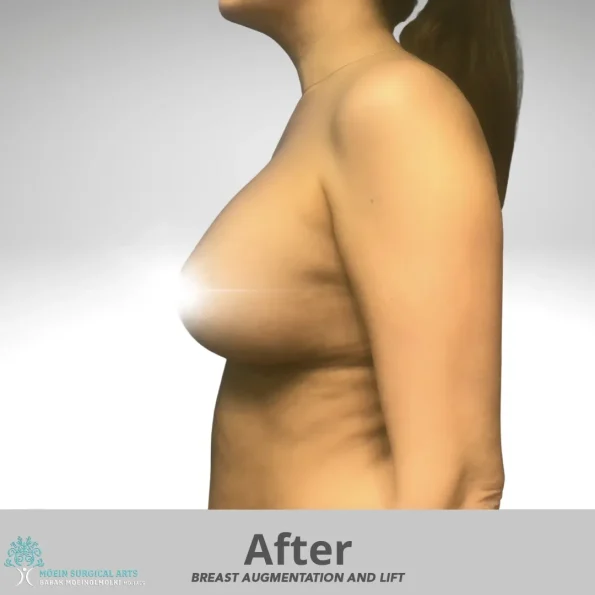 A woman's breast is shown before and after undergoing breast augmentation.