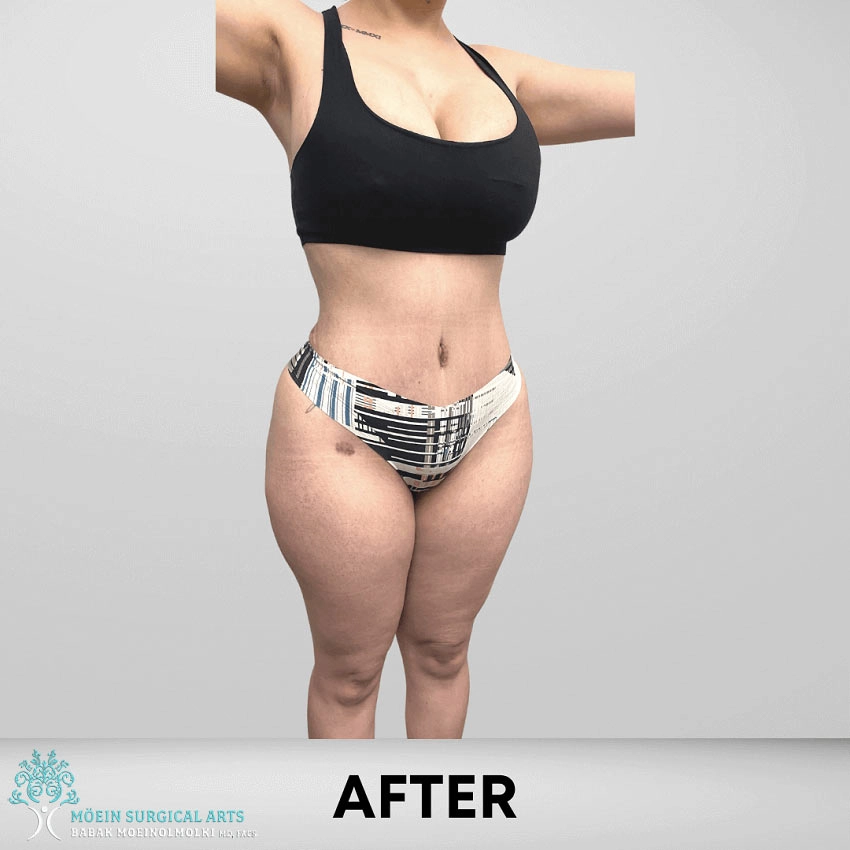 After-Tummy-Tuck-1 copia