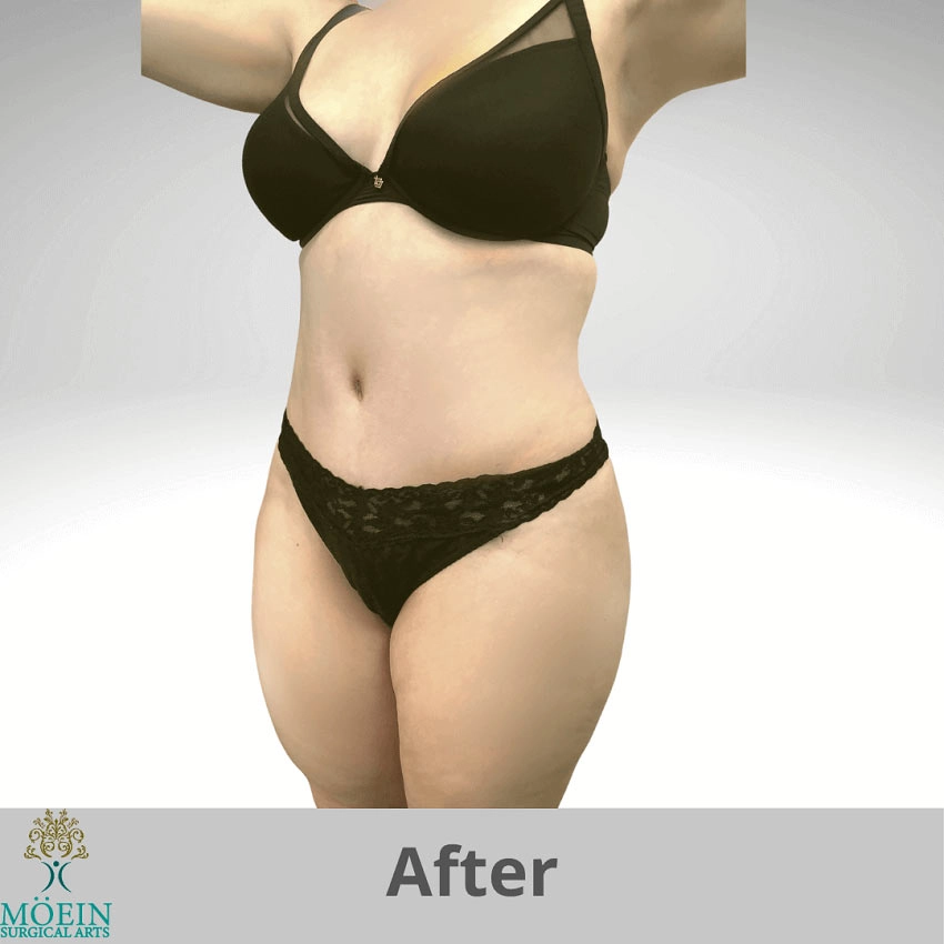 After-Tummy-Tuck copia