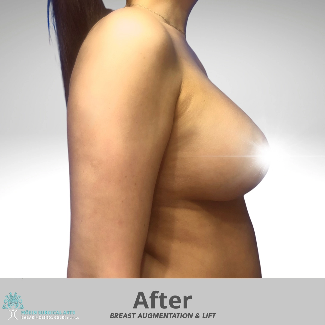 After-breast-aug-with-lift copia