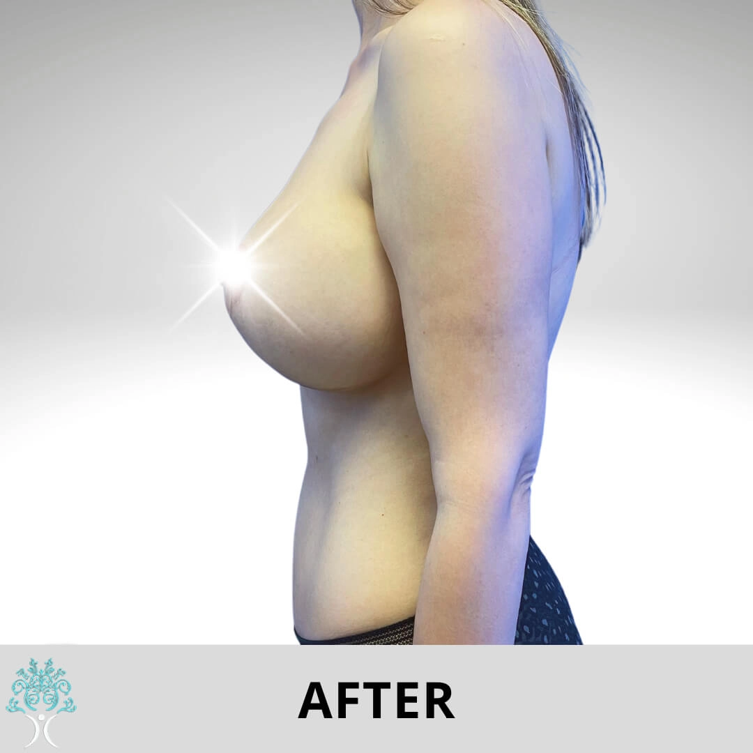 After-breast-lifte copia