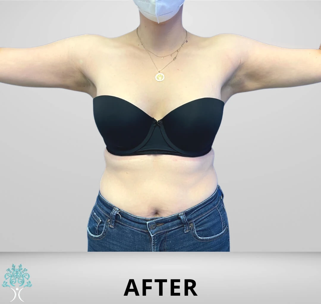 A woman with a black bra showcases her arm liposuction results before and after, while wearing a mask on her face.