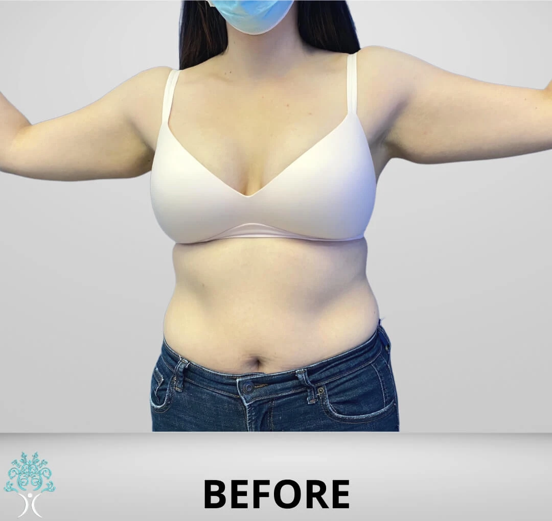 Before and after photo of a woman with tummy tuck plus arm liposuction.