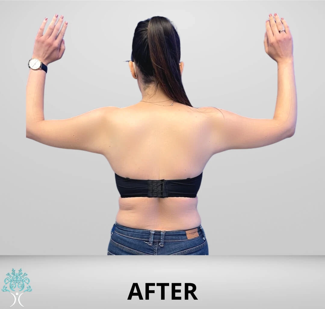 A woman's back before and after arm liposuction.