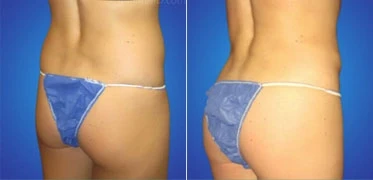 best butt augmentation with implants