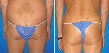 Before and after tummy tuck with butt implants.