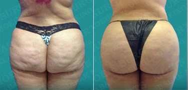 Transformation of a woman's buttocks after undergoing liposuction and butt implants.