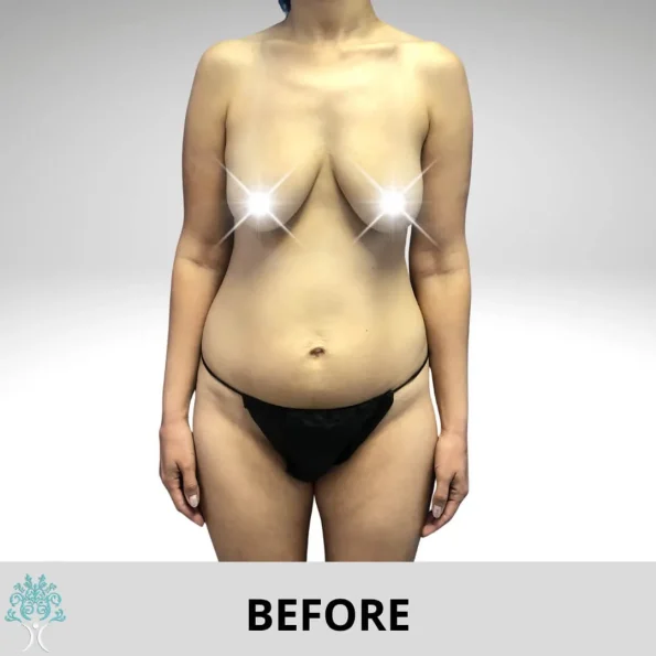 The transformation of a woman's breasts through breast lift and augmentation, displaying before and after results.