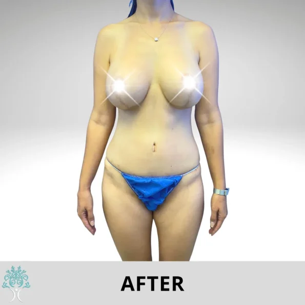 A woman's breasts before and after breast lift and augmentation surgery.