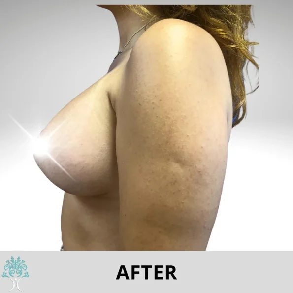 A woman's breast undergoing breast lift and augmentation before and after surgery.