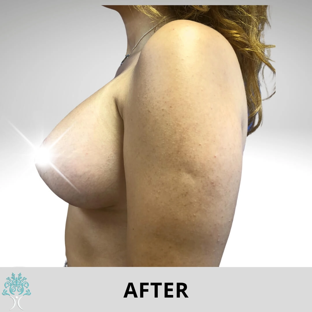 BREAST-AUGMENTATION-AND-LIFT-AFTER copia