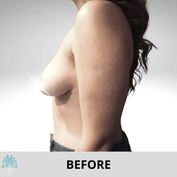 A woman's breast transformed through breast augmentation surgery.