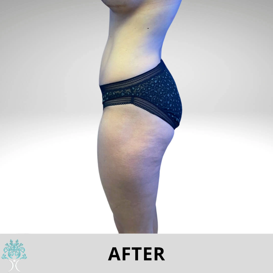 A woman's tummy before and after Brazilian Butt Lift.