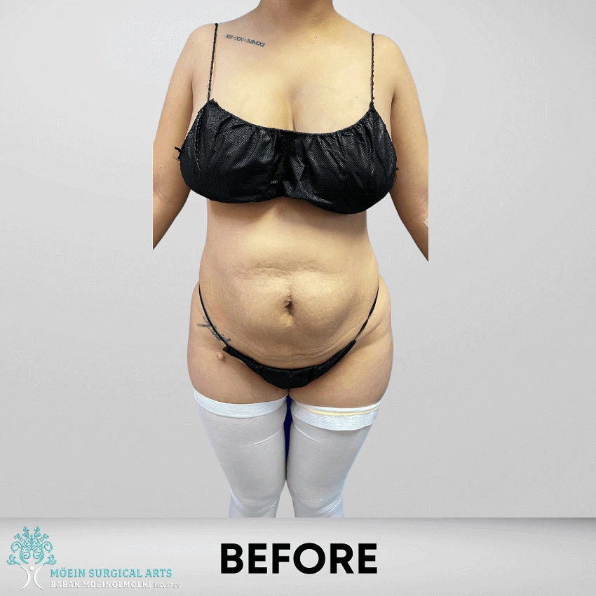 Tummy Tuck Before and After