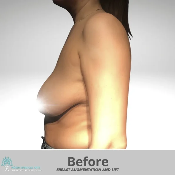 A 3D image showing breast augmentation results.