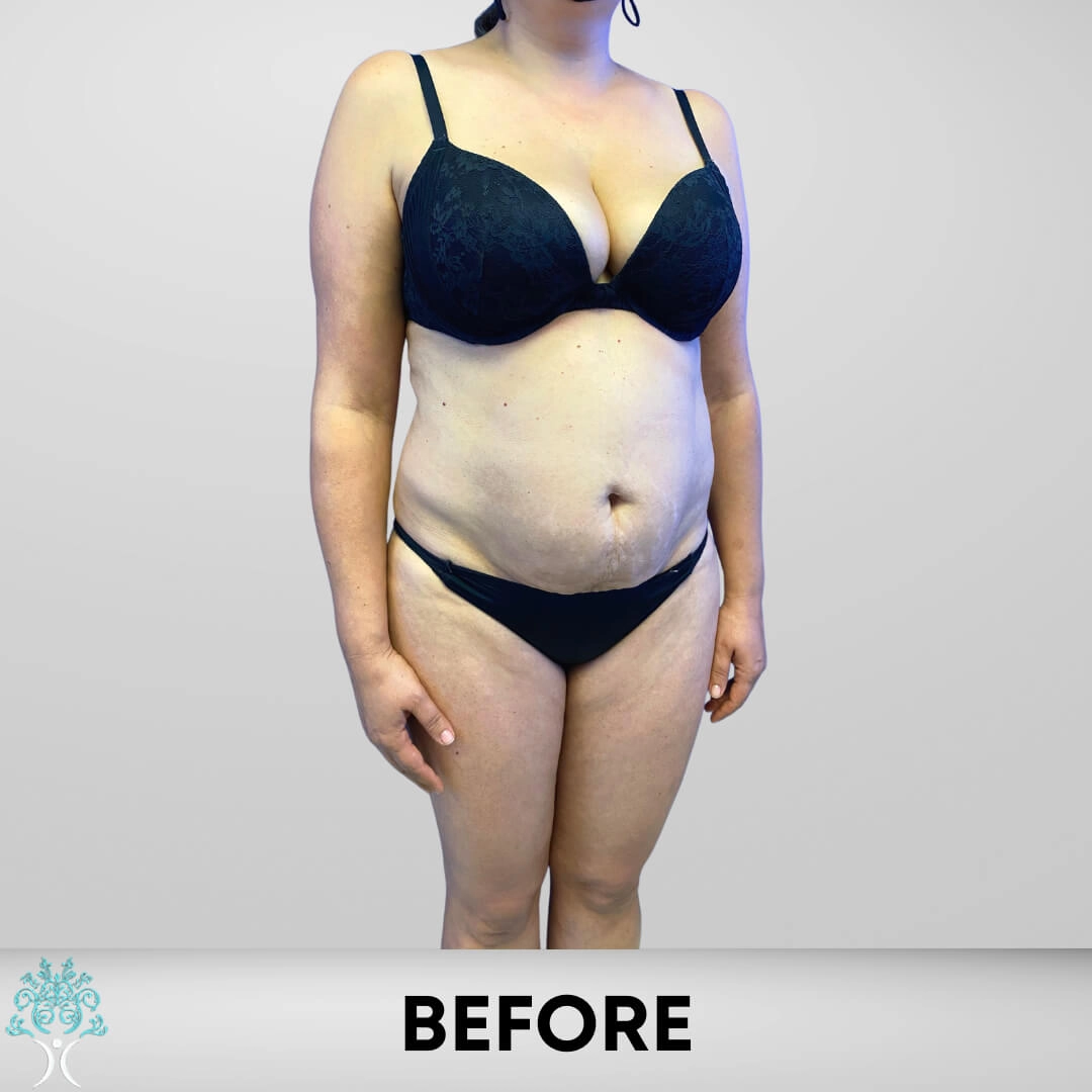 Before-Lipo copia