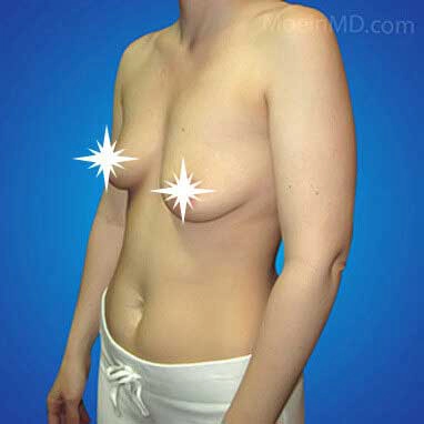 Breast-Augmentation-Lift-in-Los-Angeles-Before-1 copia