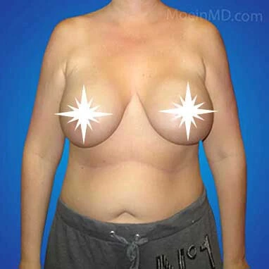 A woman's breasts before and after breast augmentation (includes keywords: breast augmentation, before and after).