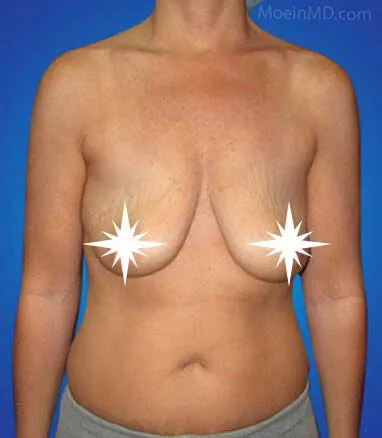 A woman's breast's transformation before and after augmentation.