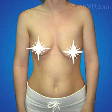 A woman's breast before and after breast augmentation.