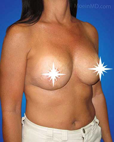 Breast-Augmentation-and-Lift-Los-Angeles-CA-after-1 copia