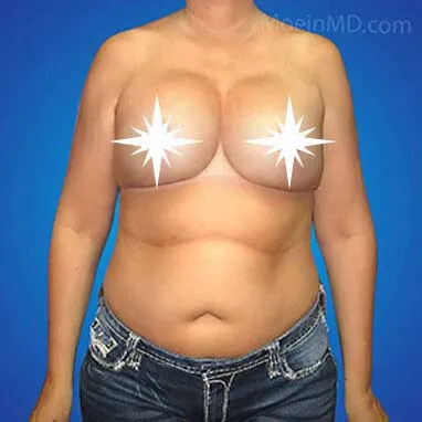 Before and after photographs showcasing the transformation of a woman's breast through breast augmentation.