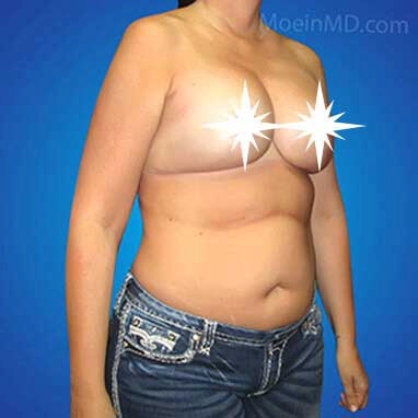 Breast-Augmentation-and-Lift-in-LA-After copia