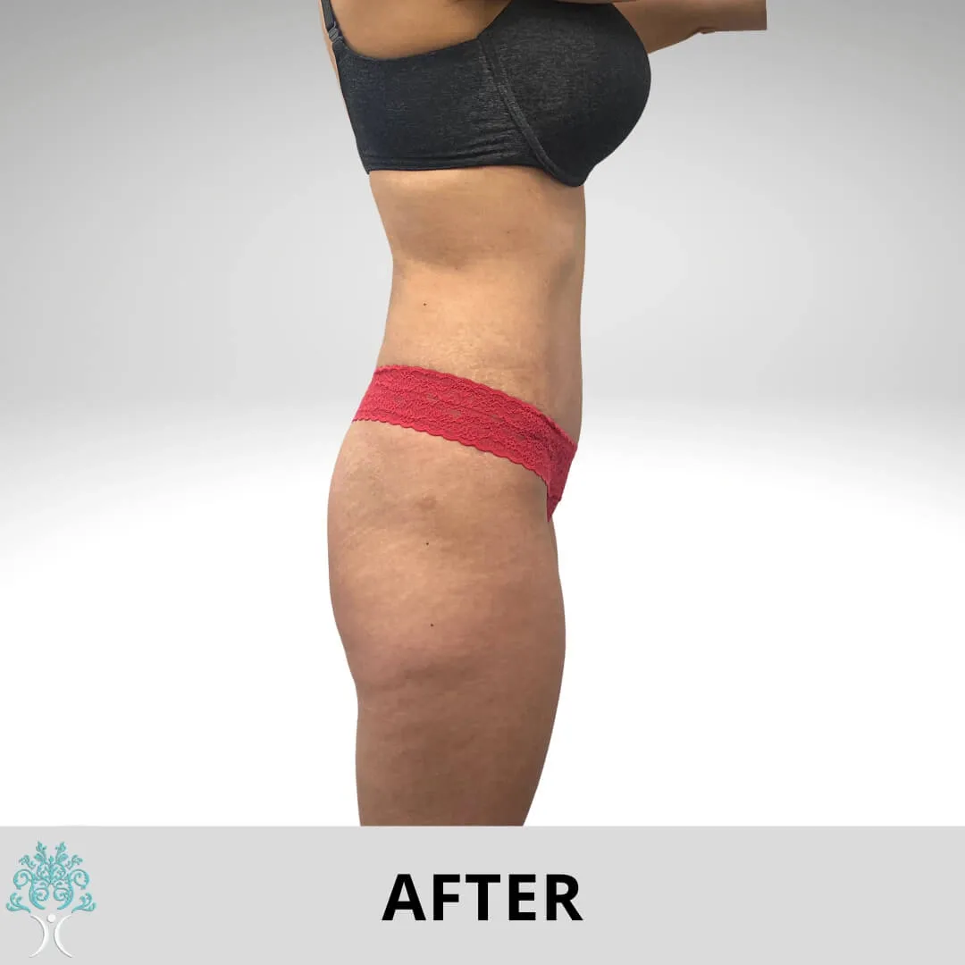 Tummy tuck and mommy makeovers before and after.