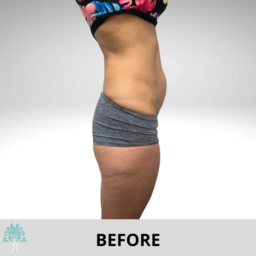 A woman's stomach before and after Mommy Makeover liposuction.