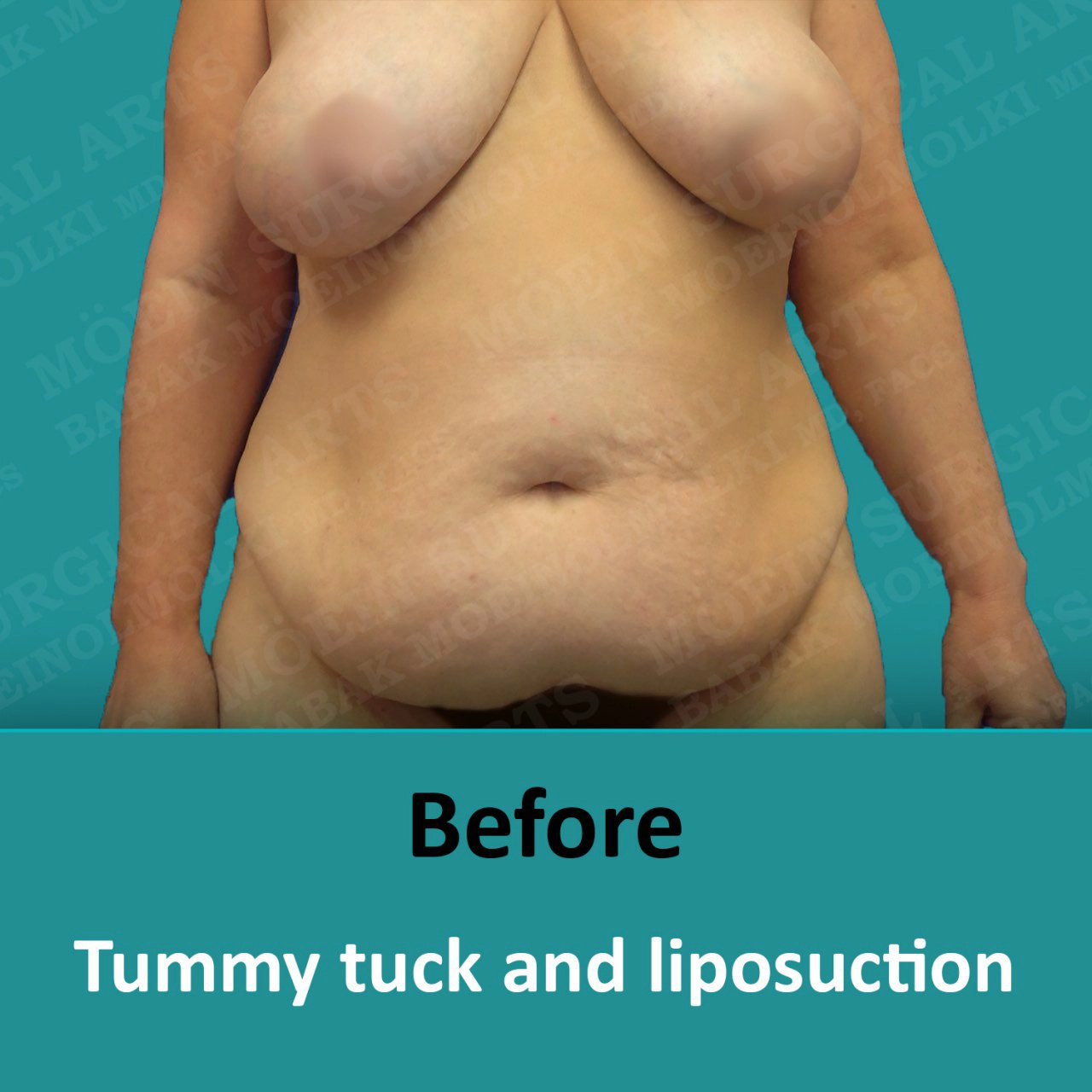 Before and after tummy tuck and liposuction with LIPOSUCTION BEFORE AND AFTER.