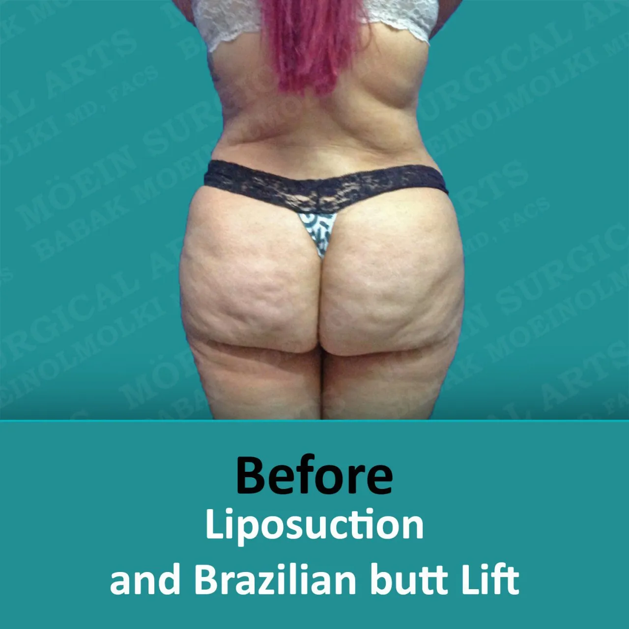 Brazilian Butt Lift transformation displayed through before and after images.