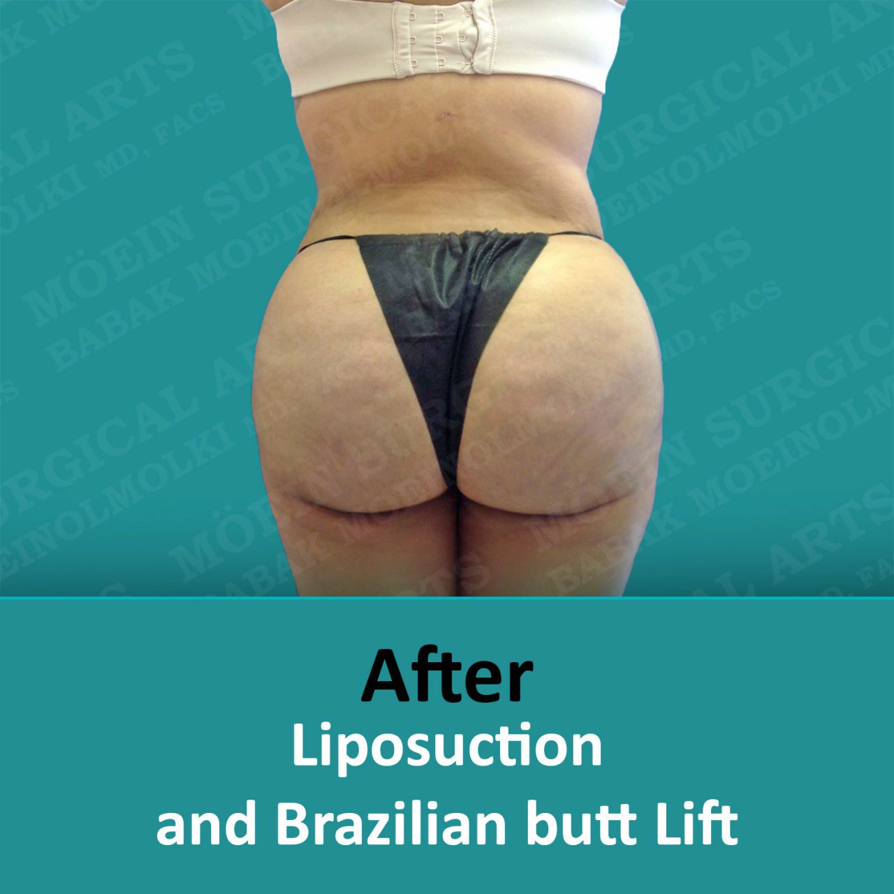 After liposuction and brazilian butt lift, see the noticeable transformation in a before and after comparison.
