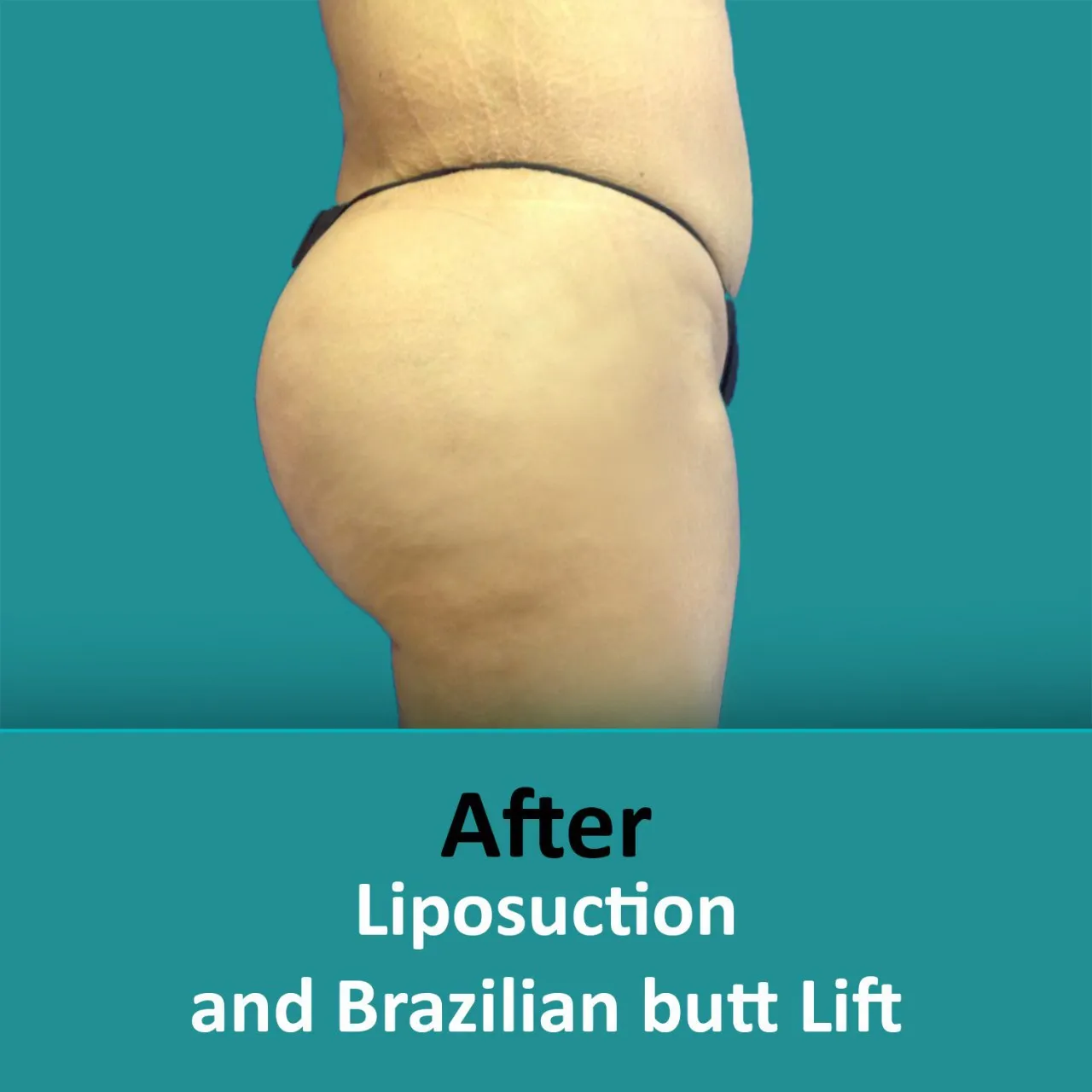 Brazilian butt lift transformation following liposuction, showcased in captivating before and after images.