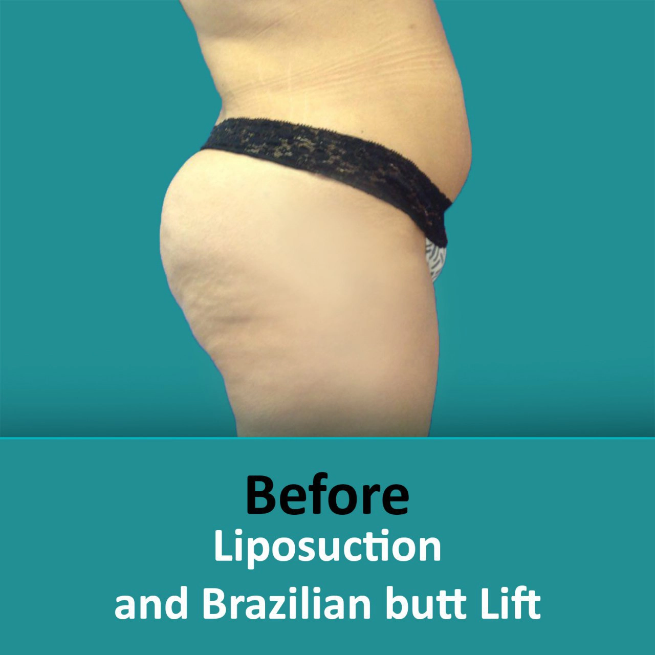 Before and after photos of liposuction.