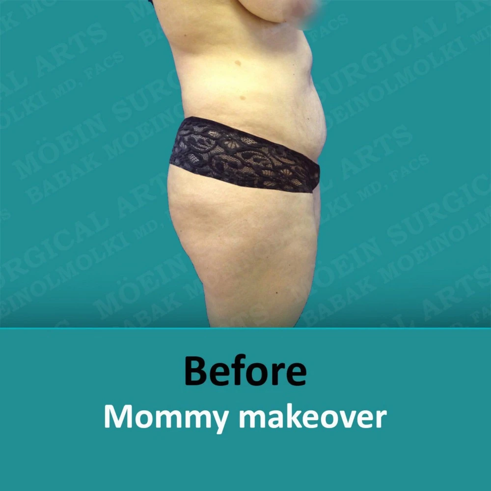 A woman's before and after images following a mommy makeover.