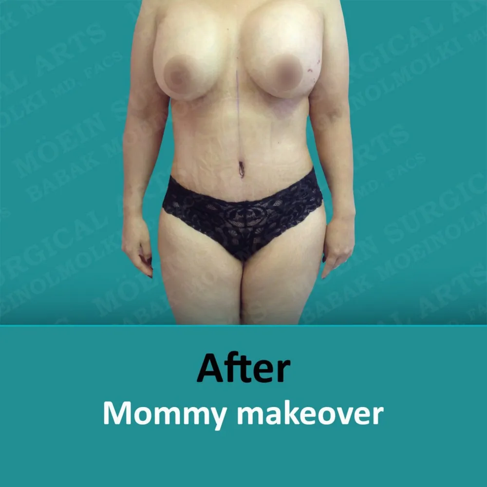 Before and after shots of a woman in a bikini showcasing the results of a mommy makeover.