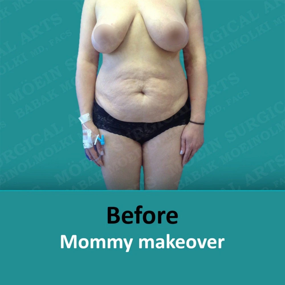 A woman's breast transformation displayed in a mommy makeover before and after.