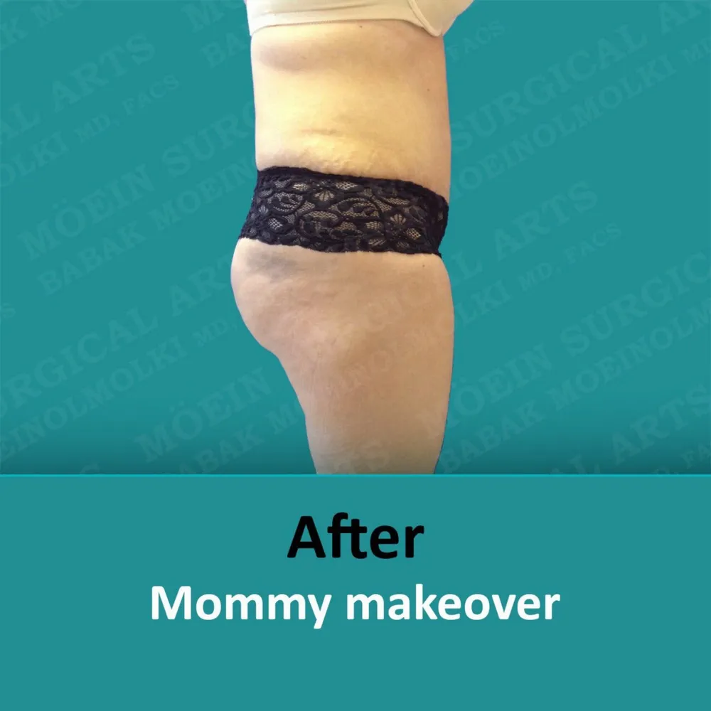 Before and after images showcasing a woman's stomach transformation post mommy makeover.